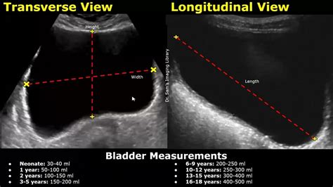 measuring bladder wall thickness ultrasound|ultrasound for bladder problems.